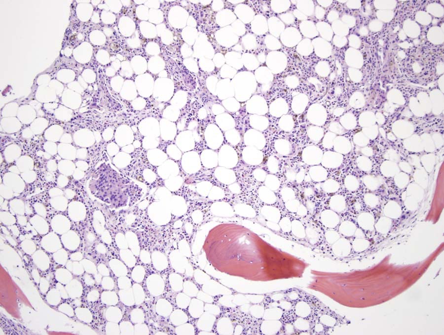 Fig 2A Refract dis BMX intrasinusoidal megakaryocytes 10x